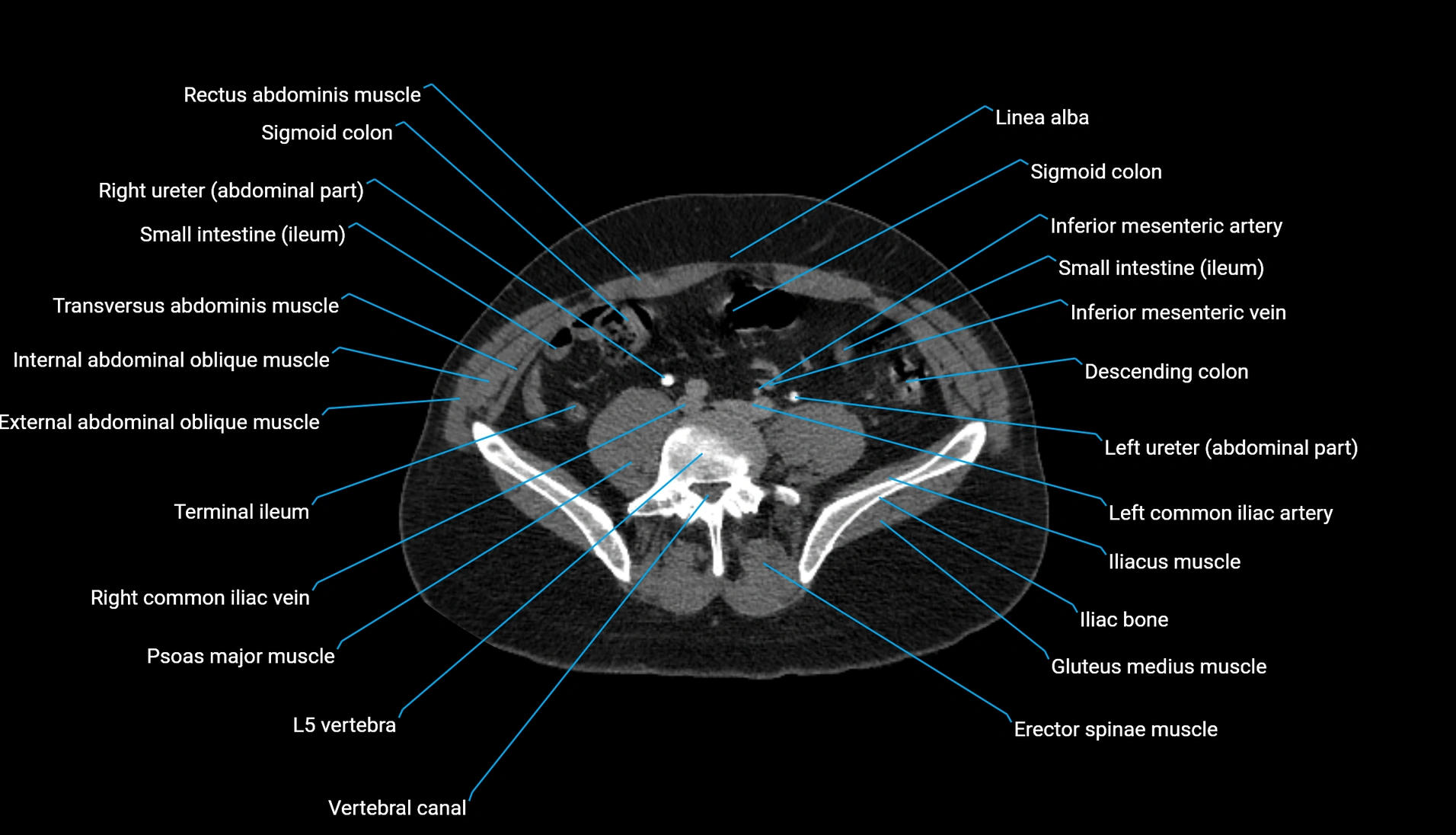 CT urogram axial cross sectional anatomy  labelled radiology image-00165.webp